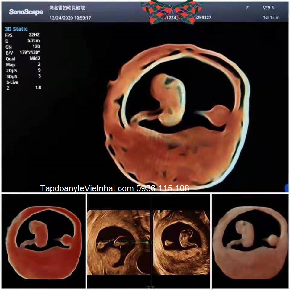 Máy siêu âm 5D trong chăm sóc sức khỏe phụ nữ: Ứng dụng và lợi ích